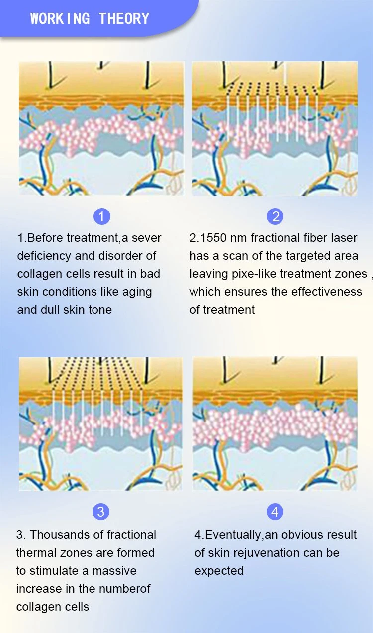 Effective Scar Repair Aesthetic Device Fiber 1550nm Laser Machine Wrinkle Removal Machine with Good Treatment Result